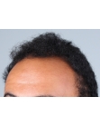 Before Hair Transplant&nbsp;Front